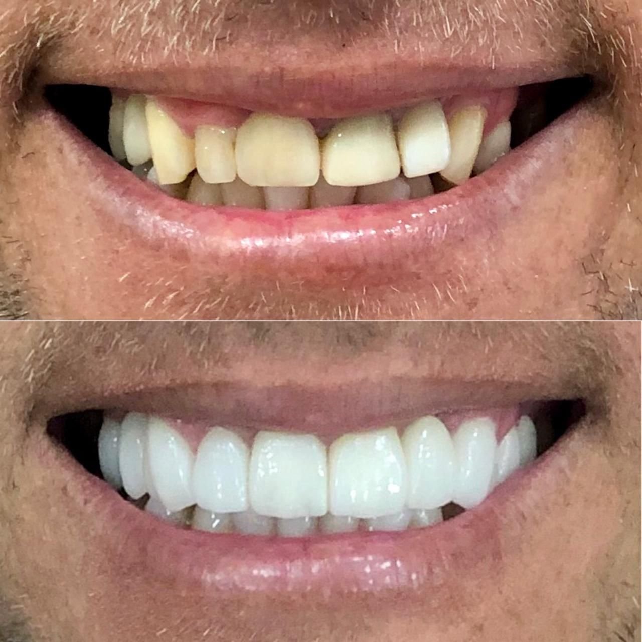 Registro de estética dental — diagnóstico inicial e resultado final