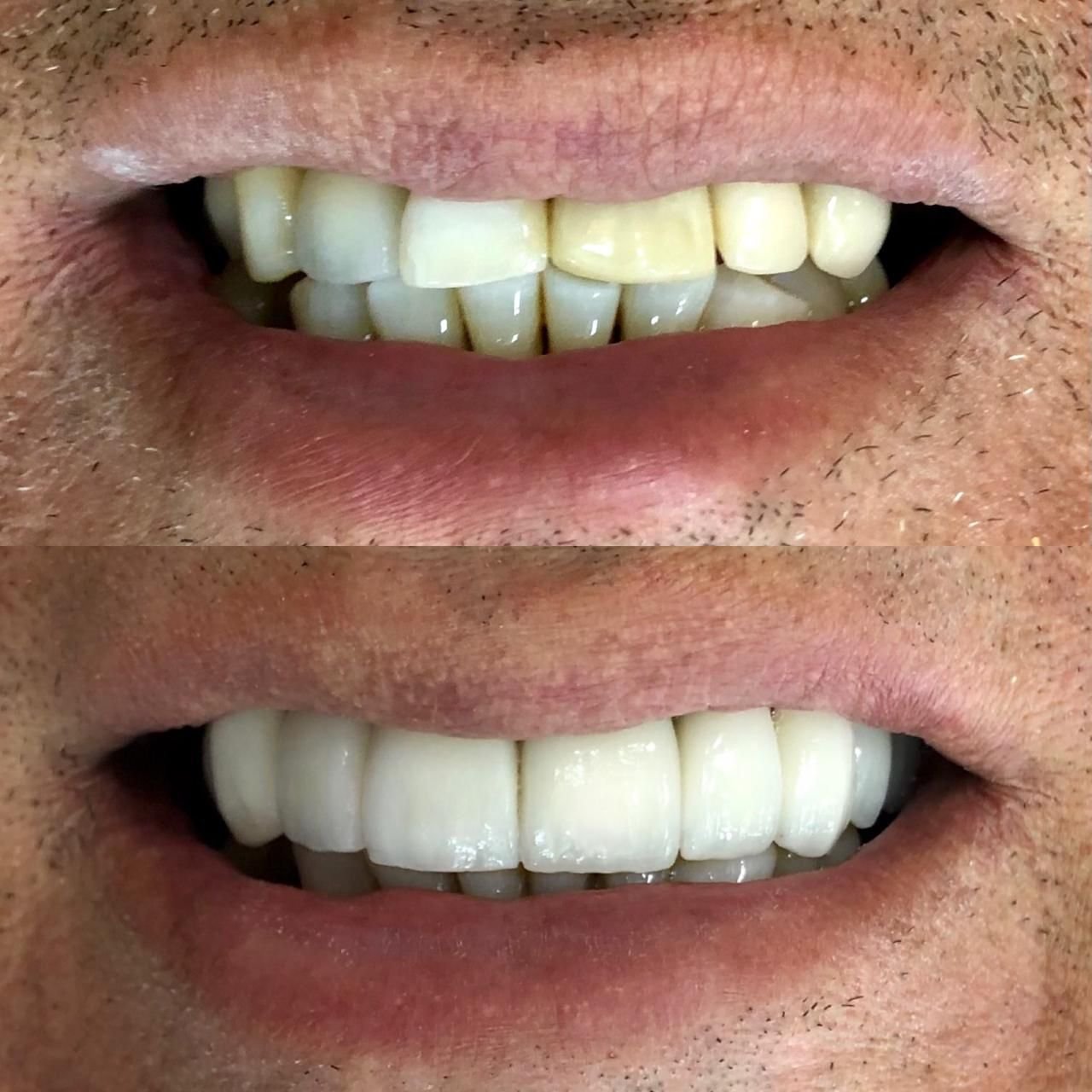 Registro de prótese dentária — diagnóstico inicial e resultado final
